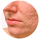 secuelas de acne tratamiento